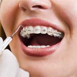 A close-up view of a mouth with braces being examined with an oral appliance