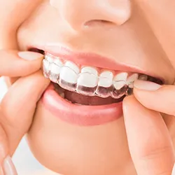 A close up view of a patient wearing her invisalign clear braces.