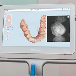 An iTero intraoral scanner capturing a detailed image of a patient's teeth and gums with precision technology, showcasing modern dental innovation.
