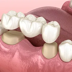 A detailed 3D illustration of a crown and bridge being applied to replace a missing tooth.