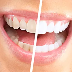 A cutaway before and after view of teeth whitening. Dingy teeth on the left give way to a bright and radiant smile on the right